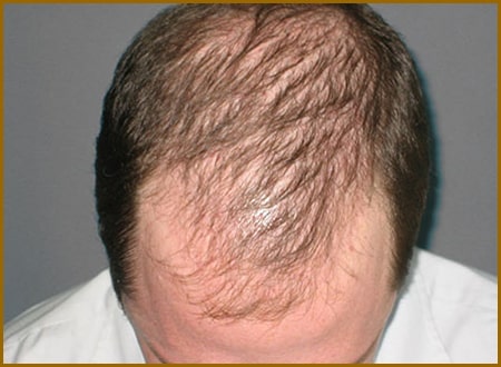 کاشت مو برای مردانی که دچار ریزش آندروژنیک هستند